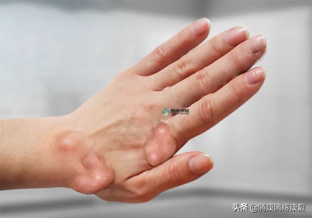 类风湿关节炎病因与发病机制,类风湿关节炎的病因与发病机制