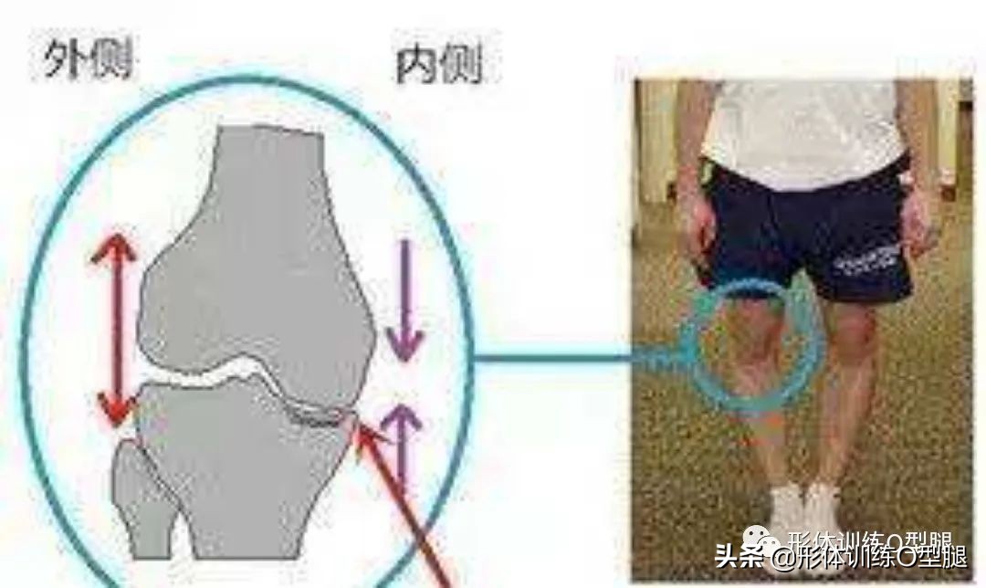 怎样矫正o型腿罗圈腿,罗圈腿和o型腿是怎么形成的