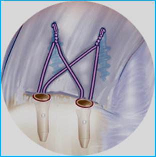 肩袖损伤手术后多长时间完全恢复,肩袖损伤手术后一般多久能恢复