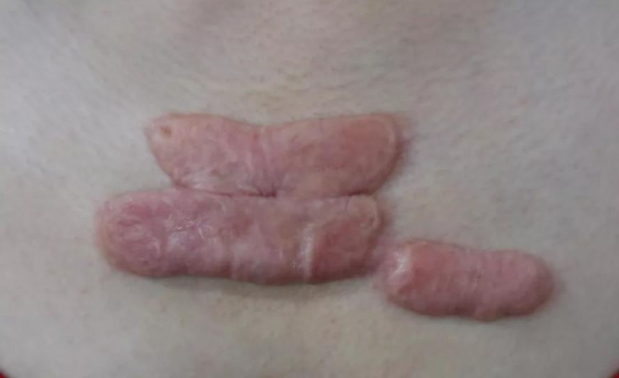 胸前疤痕疙瘩不去掉有什么危害,胸前疤痕疙瘩需要治疗吗