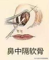 耳软骨加鼻中隔隆鼻价格多少,鼻中隔软骨隆鼻3d动画演示