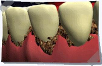 大连齿医生口腔科普5种常见行为习惯,让你牙龈越来越脆弱