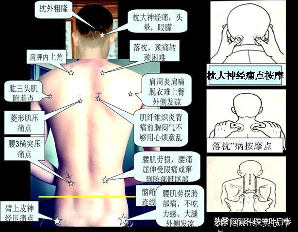 放血疗法很痛吗,肩膀痛放血流出血块