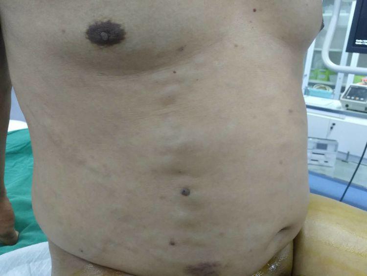 热烈祝贺太原市中心医院血管外科府城病区布加综合征介入治疗成功