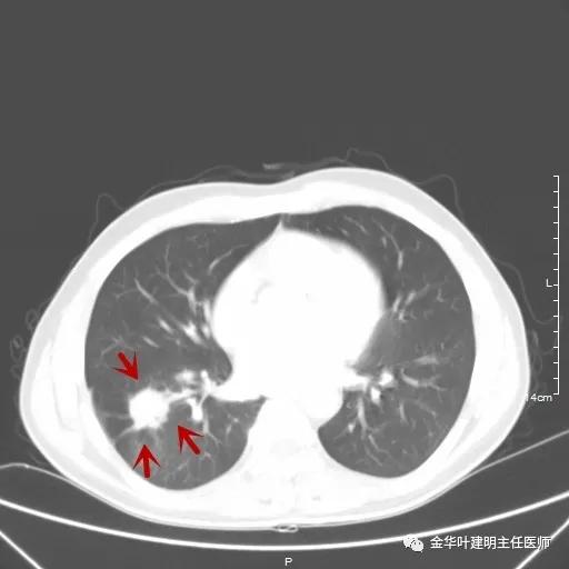 伴有脑转移了的肺癌能手术吗?