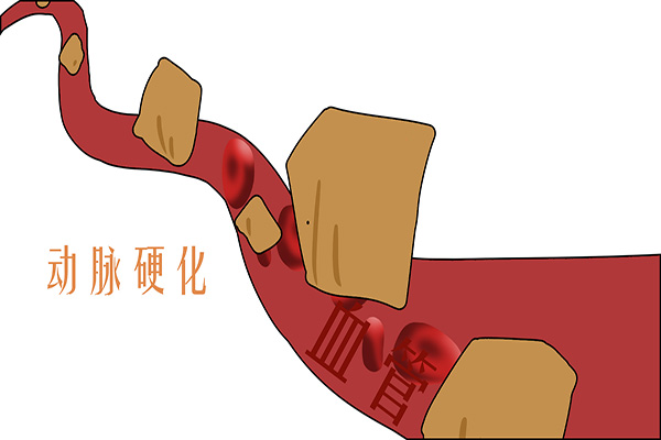 中风“来势汹汹”！哪些人更易患中风？预防中风，或需规避4点！