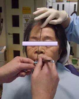 咬合重建的程序,咬合重建做嵌体