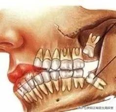「科普」还在纠结是否拔智齿？看完你就明白了