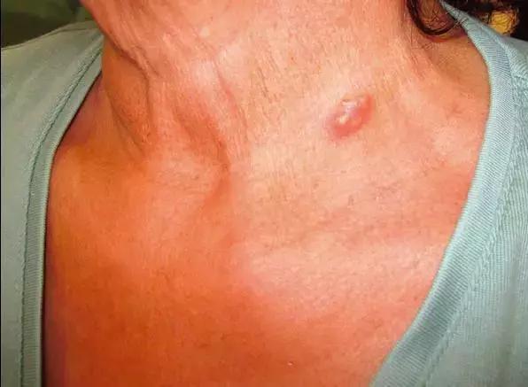 28岁小伙癫痫16年，脑子被虫吃了！竟是爸爸给他吃这个珍稀“大补”！