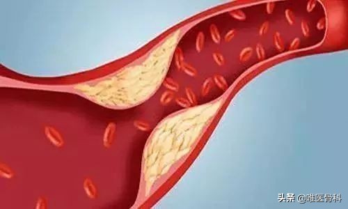 膝关节置换后血栓多长时间能消除,膝关节置换后血栓发病