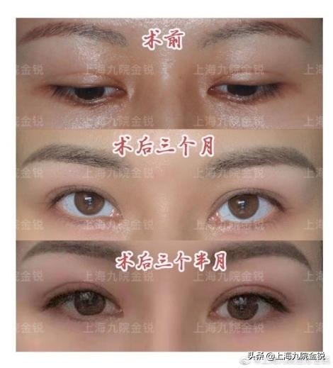 双眼皮VS单眼皮，为什么更多人喜欢双眼皮？