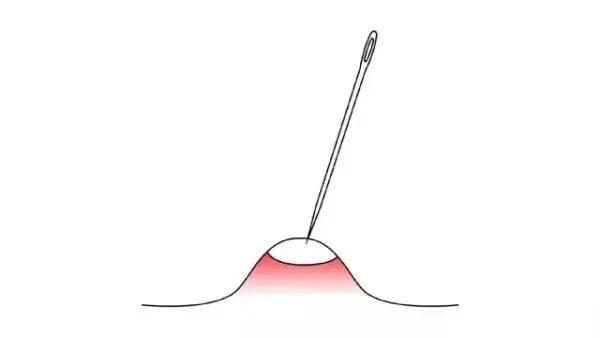 挤痘痘挤到一半就挤不出来了,痘痘挤破了怎么快速消痘