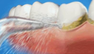 牙龈肿痛吃药不好,上火引起牙龈肿痛十大消炎药