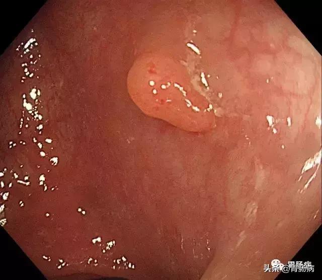 大肠息肉—藏在肚子里的定时*弹炸**，只要发现，必须格杀勿论！