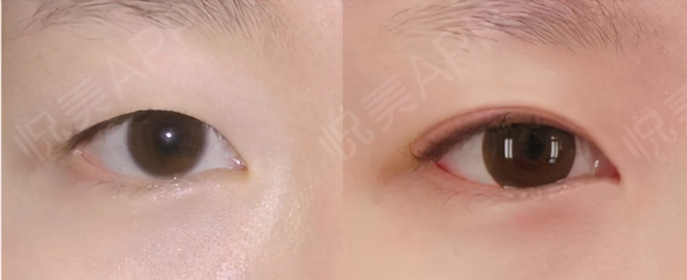 双眼皮有几种眼型哪种好看,如何选择自己适合哪种双眼皮