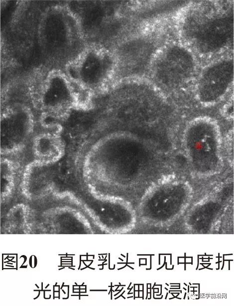 皮肤共聚焦显微镜能查什么,皮肤镜和共聚焦显微镜