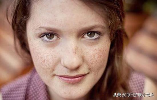 淡斑改善皮肤暗黄,皮肤怎样补水淡斑