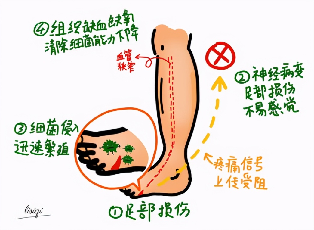 糖尿病神经病变,可选用这些药物治疗