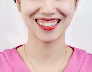 一笑就露牙龈怎么办,一笑牙龈露太多怎么治疗