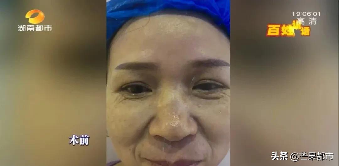 长沙法令纹改善,手术去除法令纹的效果到底怎么样