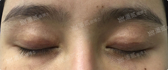 双眼皮失败眼角处有褶皱,双眼皮失败后闭眼痕迹