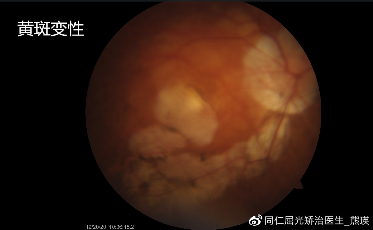 眼科护理手册最新版,眼底病科普手册