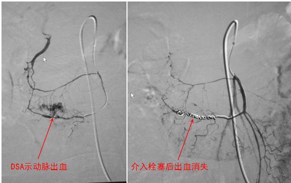 尿血便血同时出现怎么办,便血尿血去看什么科