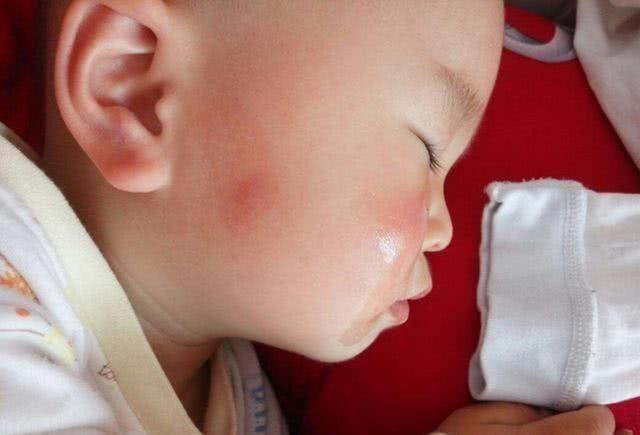 孩子被咬后,若呈现这些状况代表不是蚊子咬的包,别自行处理