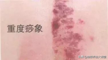 刮痧时出现的痧是啥样的,刮痧出痧消退过程中颜色变化