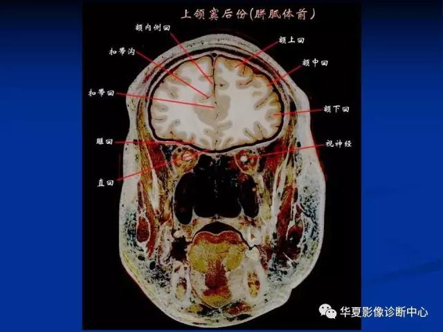 电子版头颅ct与mri断层解剖,头颅mri血管解剖与分段详解