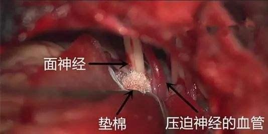 眼跳神经痉挛针灸,继发性的面肌痉挛好治疗