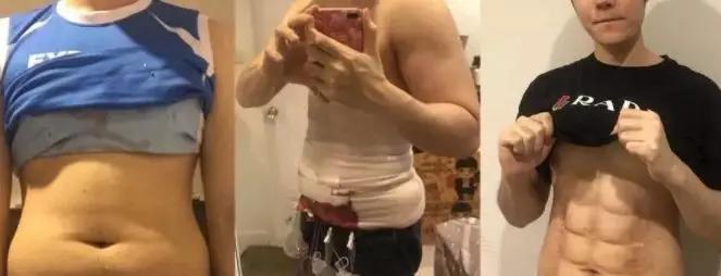 泰国抽脂腹肌,国外腹部抽脂真人演示