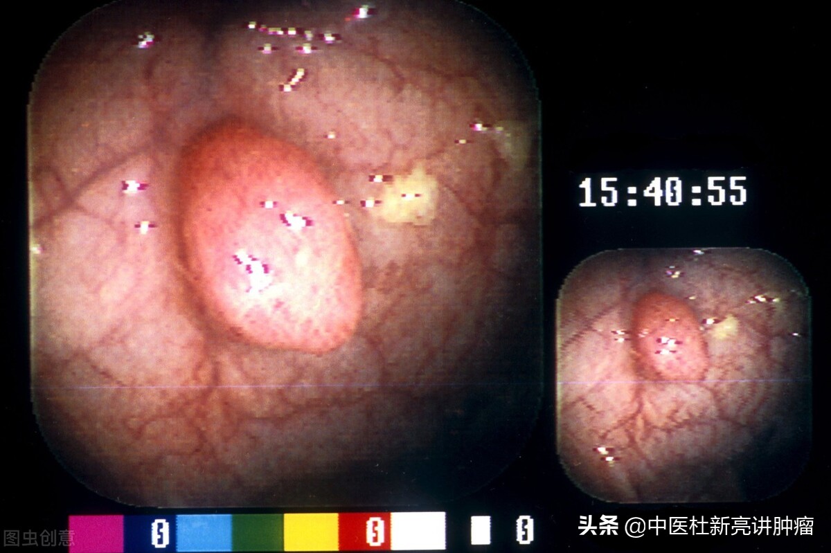 胃息肉术后防治及用药,胃息肉做完手术后穿孔怎么治疗