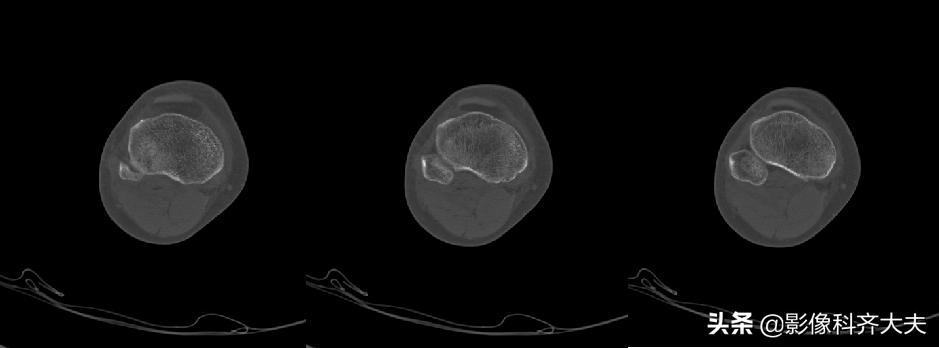 骨折的影像学检查及各自的优势,骨折的影像学愈合标准