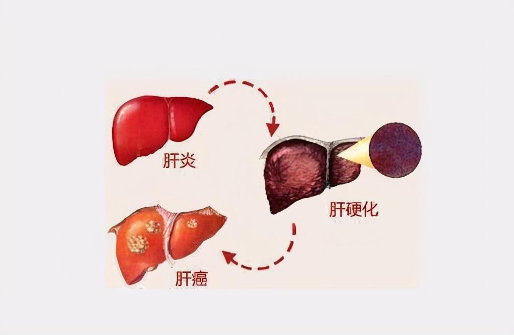 肝硬化导致肝衰竭有保守的方法吗,肝硬化为什么要注意保肝