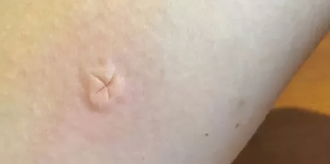 从小就吸引蚊子被蚊子咬,容易挨蚊子咬的原因