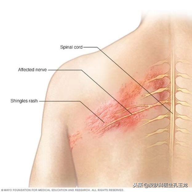 带状疱疹结痂后疼痛难忍怎么办,皮肤科常见的瘙痒症