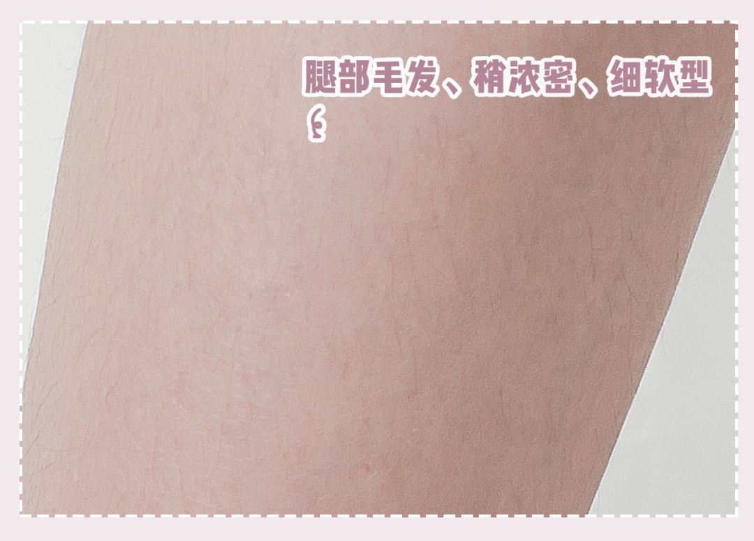 体毛脱毛的效果怎么样,天生体毛旺盛的人正常吗