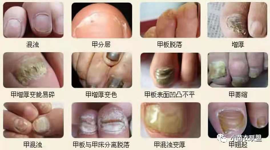 验方治愈一切真菌感染皮肤病,远离真菌