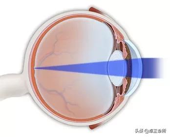 小孩眼睛近视散光怎么改善,眼睛散光近视要怎么改善