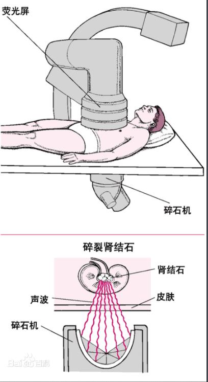 体外冲击波碎石取石术,体外冲击波碎石多少钱一次
