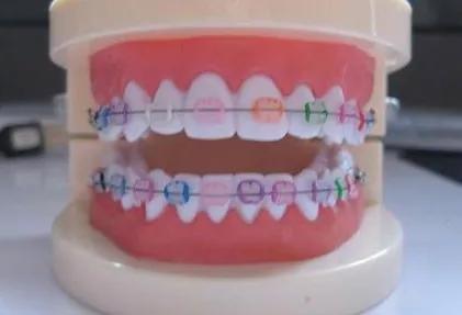 戴牙套前必须知道的事,戴牙套全过程及后期问题