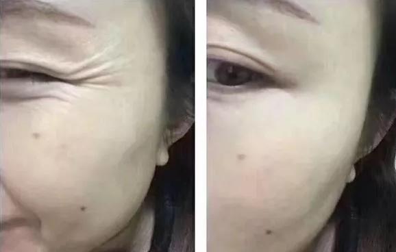 鱼尾纹眼袋怎么去除最有效,去除眼袋鱼尾纹最快最好的方法