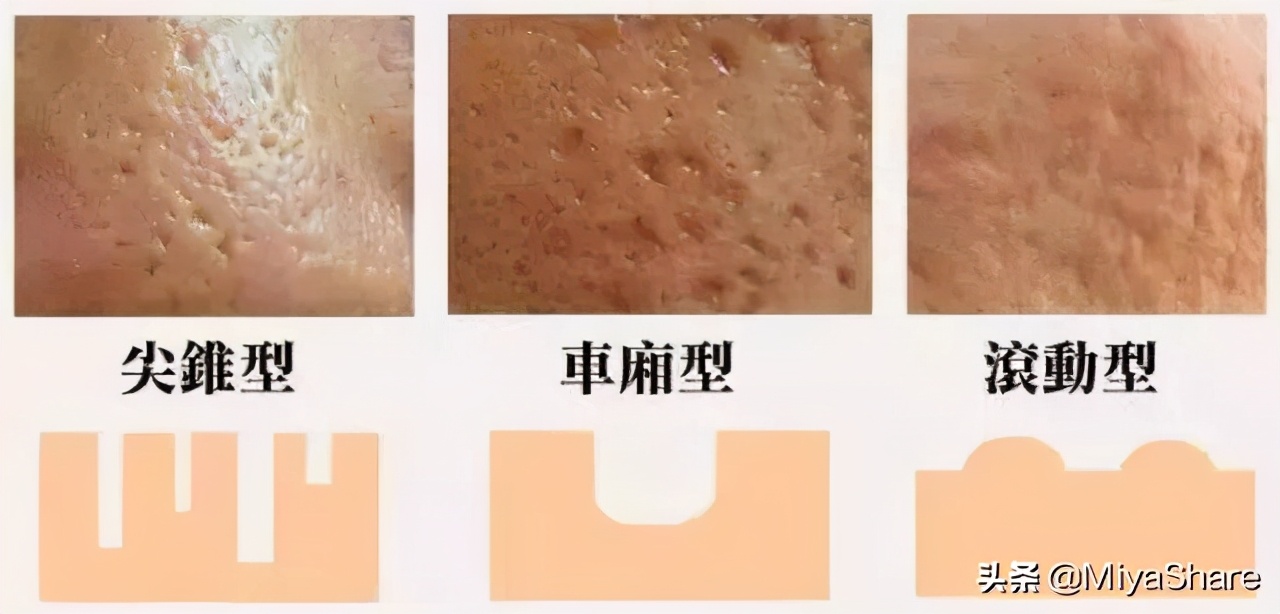 毛孔粗大收缩毛孔最有效的老土法,毛孔粗大怎么办这些小妙招学起来