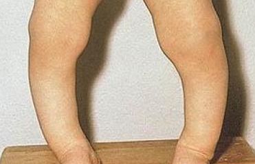 佝偻病的一些预防与治疗