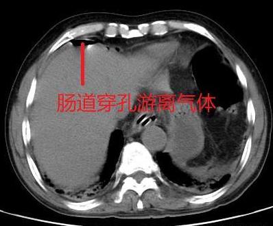 腹痛急剧怎么办？当然是快速准确诊断病因最重要，否则没法治疗