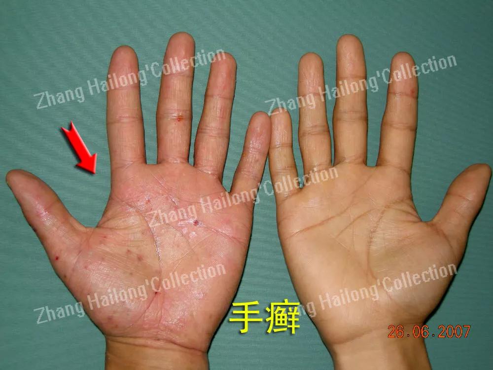手特别干燥粗糙会是手癣吗,得了手癣指头皮肤变粗糙怎么办