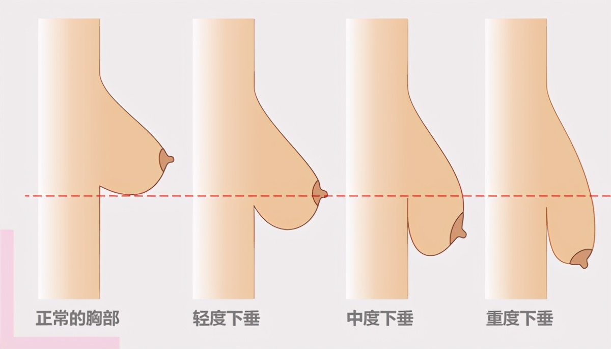 乳房下垂的真相,医美如何改善胸部下垂