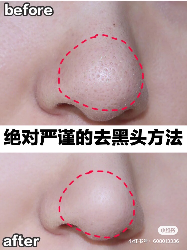 毛孔粗大怎么改善和调理,毛孔粗大到底怎么办学生