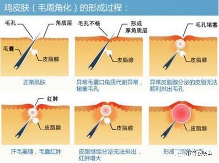 毛囊根部有凸起像鸡皮疙瘩痒,大腿毛囊有粉刺一样的疙瘩